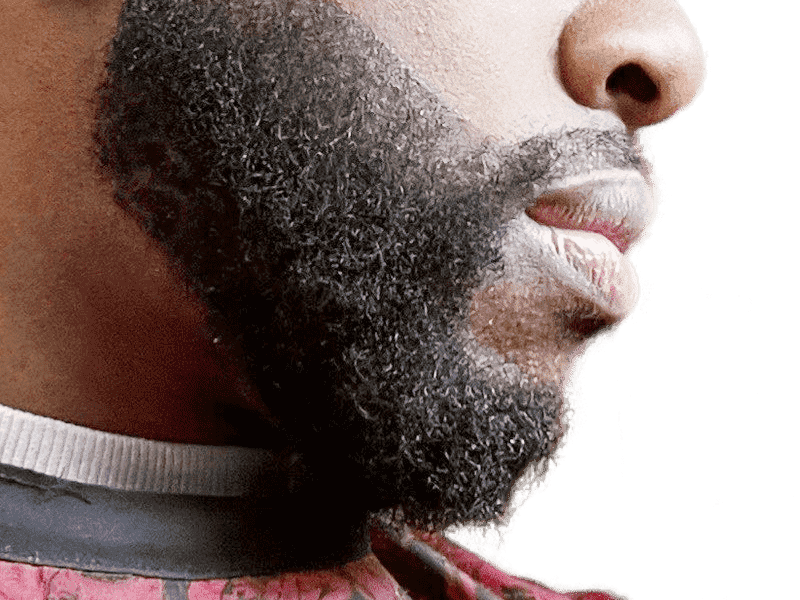 Beard Transplant Case 1 – After
