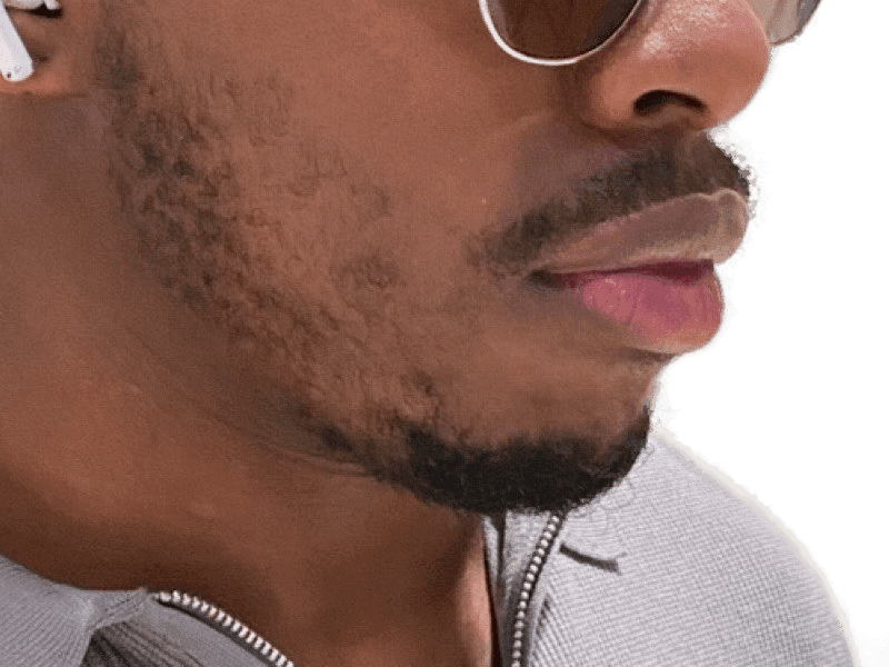 Beard Transplant Case 1 – Before