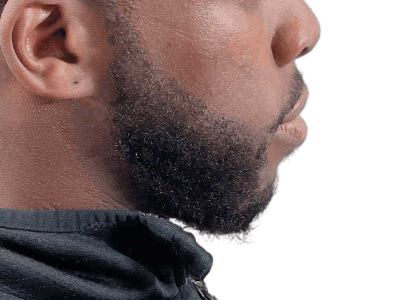 Beard Transplant Case 1 – After