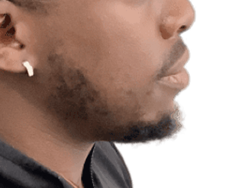 Beard Transplant Case 1 – Before