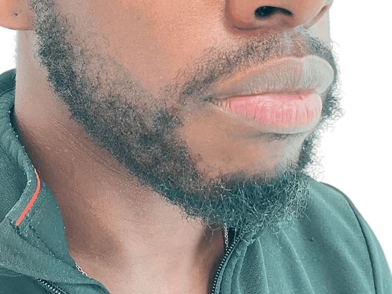 Beard Transplant Case 1 – After