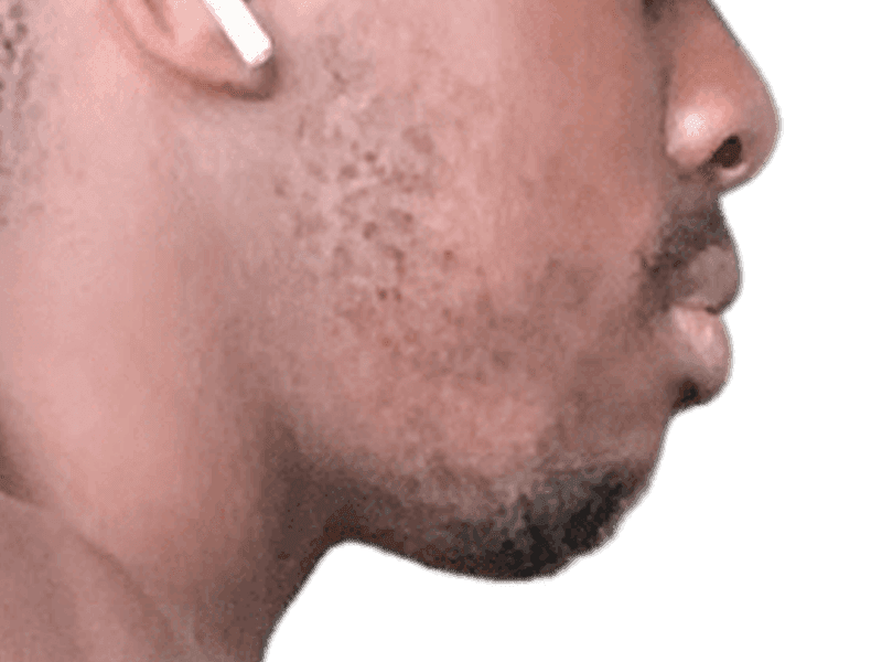 Beard Transplant Case 1 – Before