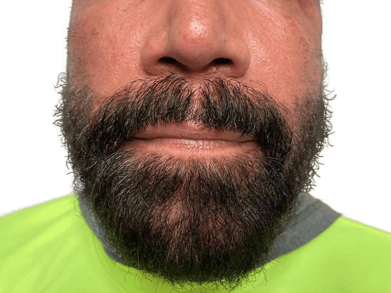 Beard Transplant Case 10 – After