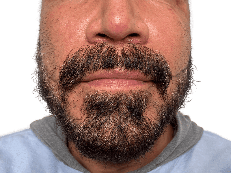 Beard Transplant Case 10 – Before