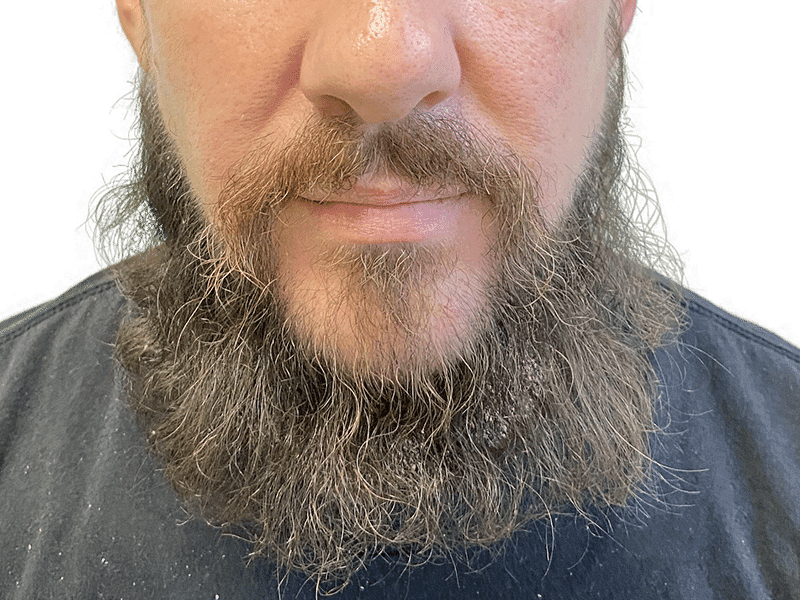 Beard Transplant Case 11 - After