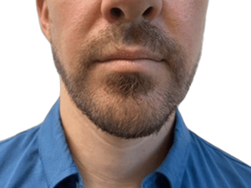 Beard Transplant Case 11 - Before
