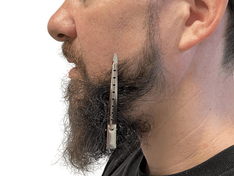 Beard Transplant Case 11 – After