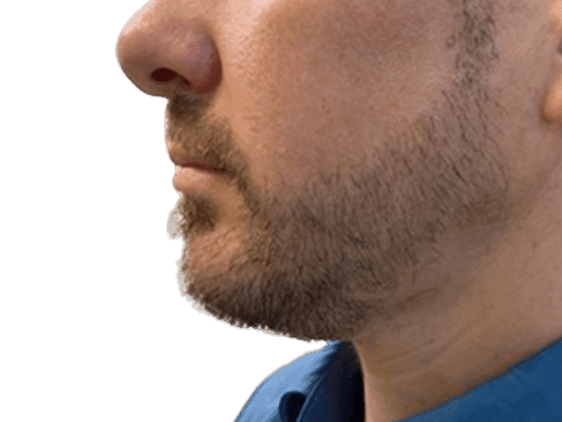 Beard Transplant Case 11 - Before