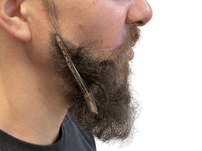 Beard Transplant Case 11 - After