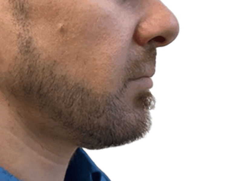 Beard Transplant Case 11 - Before