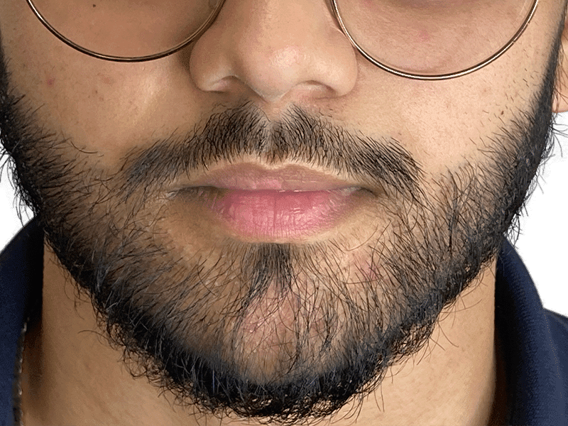 Beard Transplant Case 12 - After