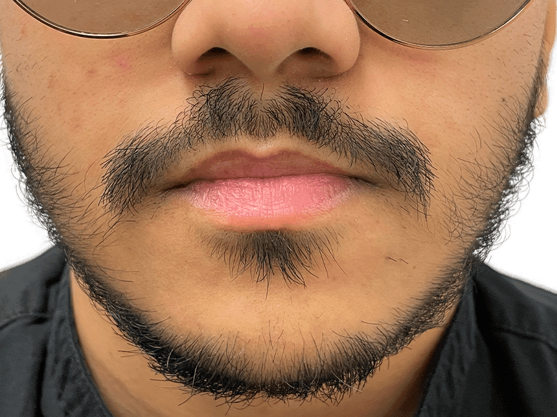 Beard Transplant Case 12 - Before