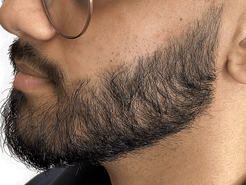 Beard Transplant Case 12 - After