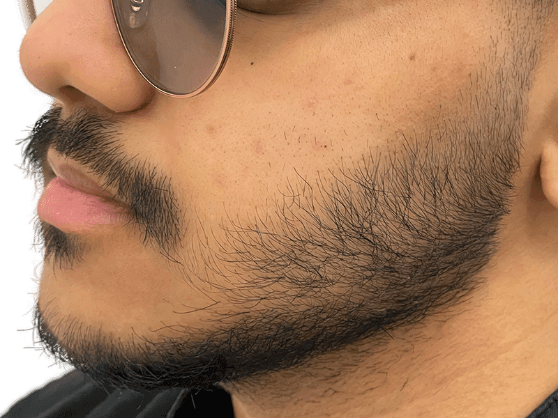 Beard Transplant Case 12 - Before