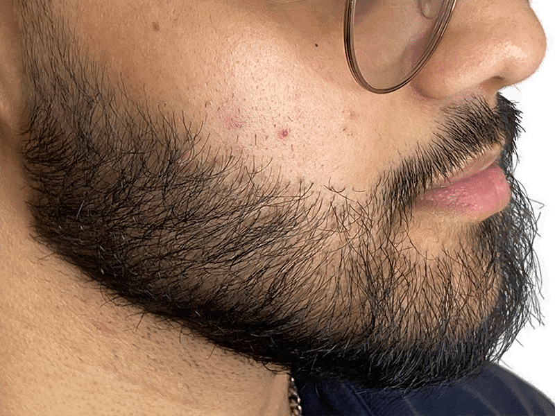 Beard Transplant Case 12 - After