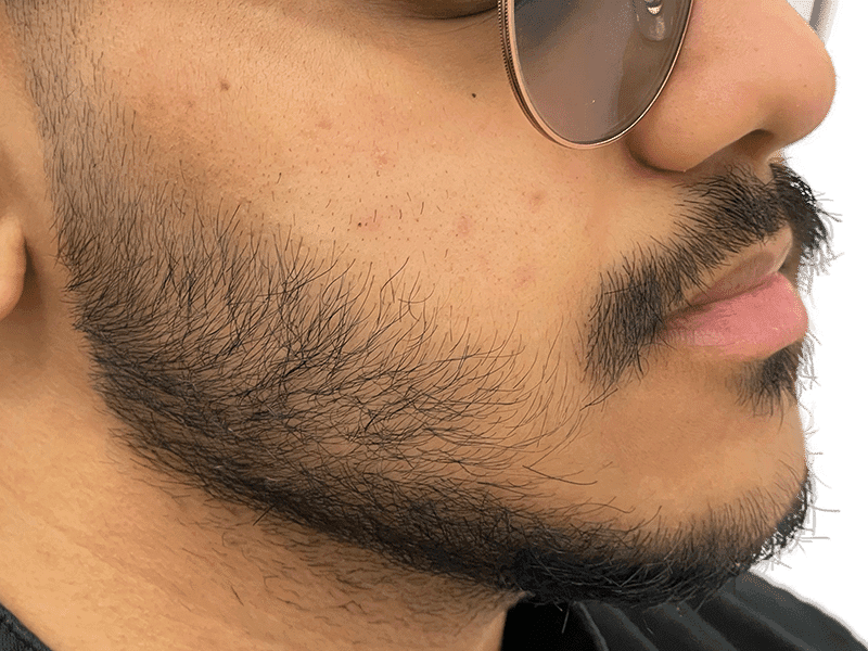 Beard Transplant Case 12 - Before