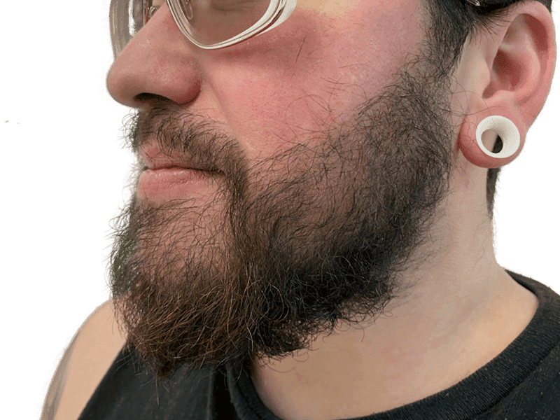 Beard Transplant Case 2 – After