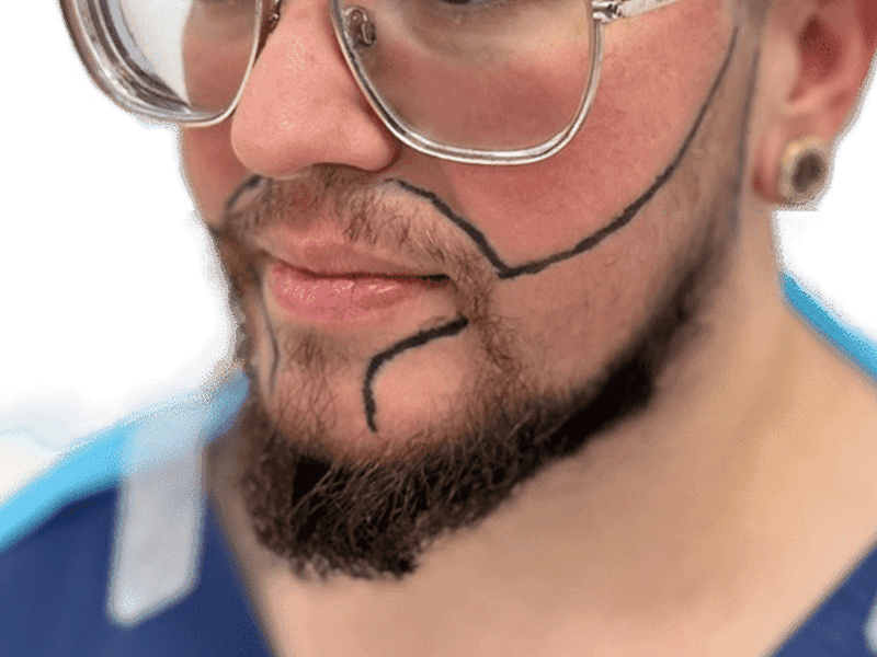 Beard Transplant Case 2 – Before