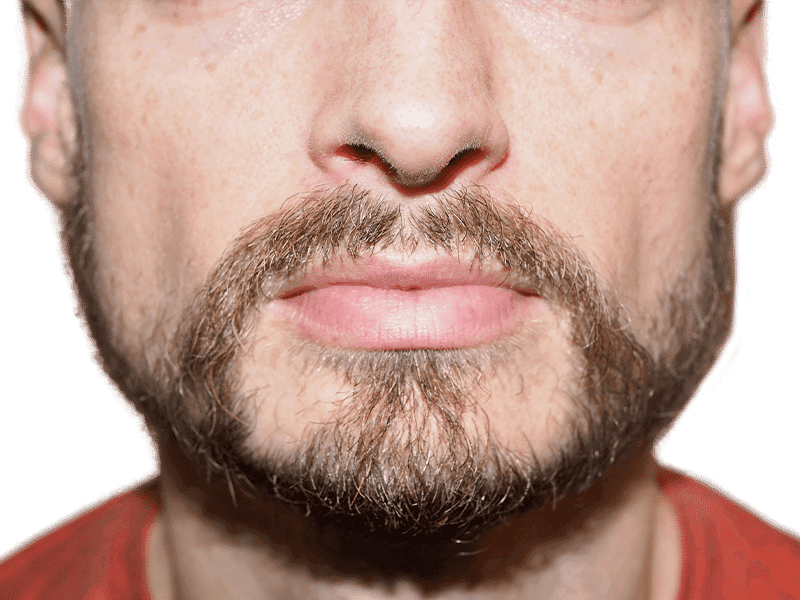 Beard Transplant Case 3 – After