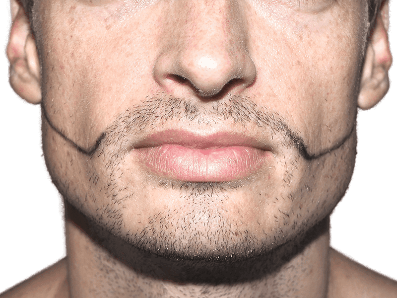 Beard Transplant Case 3 – Before