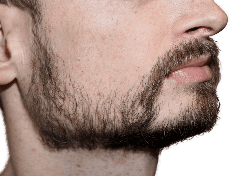 Beard Transplant Case 3 – After