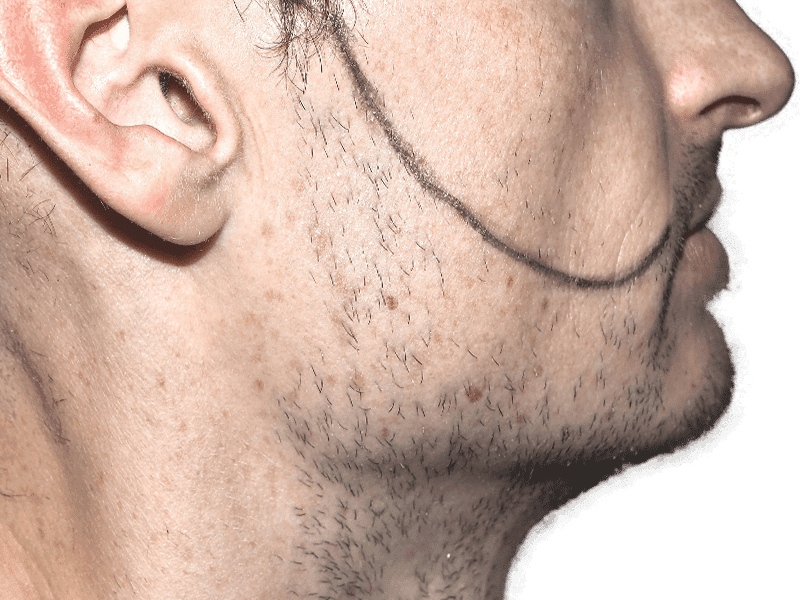 Beard Transplant Case 3 – Before