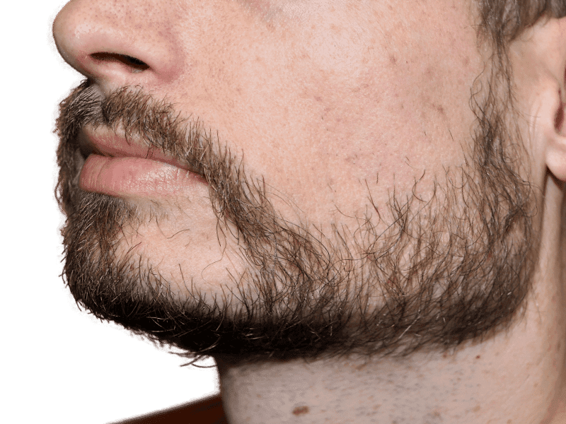 Beard Transplant Case 3 – After