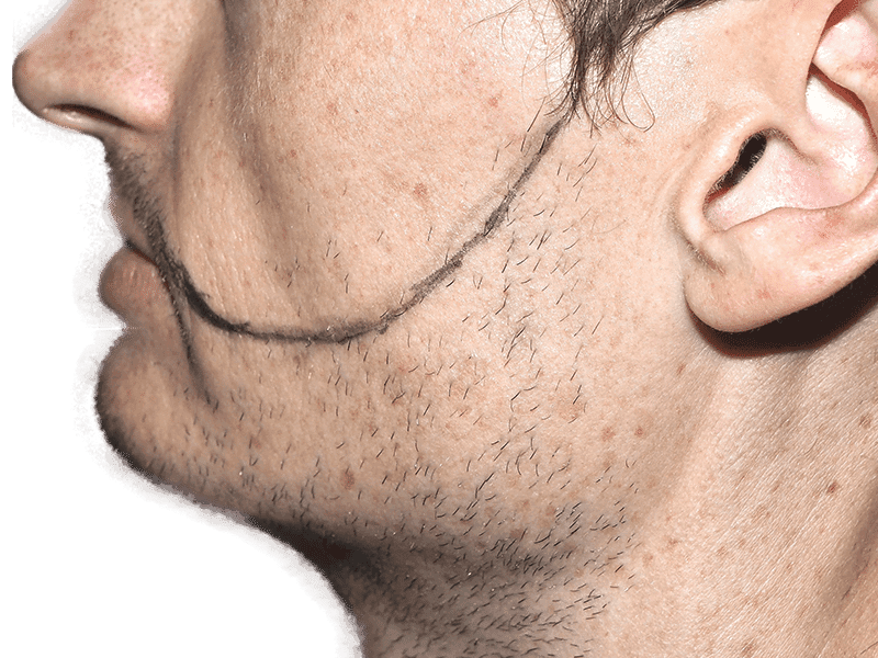 Beard Transplant Case 3 – Before