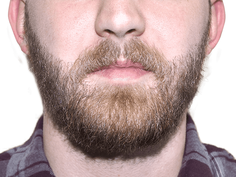 Beard Transplant Case 4 – After