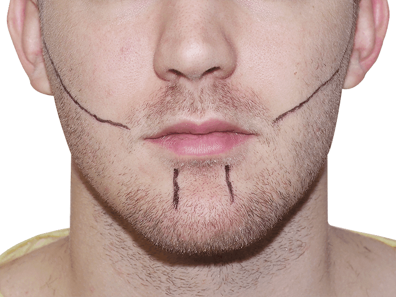 Beard Transplant Case 4 – Before