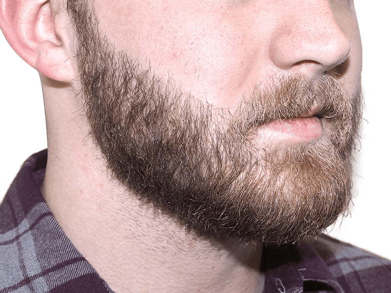 Beard Transplant Case 4 – After