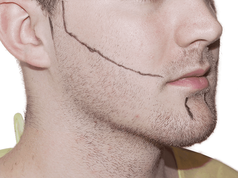 Beard Transplant Case 4 – Before