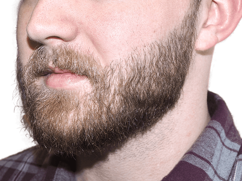 Beard Transplant Case 4 – After
