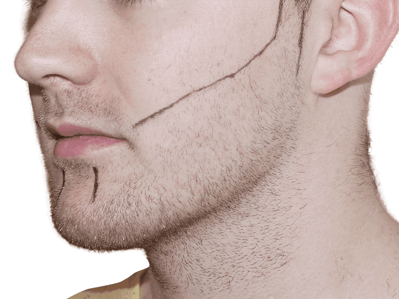 Beard Transplant Case 4 – Before