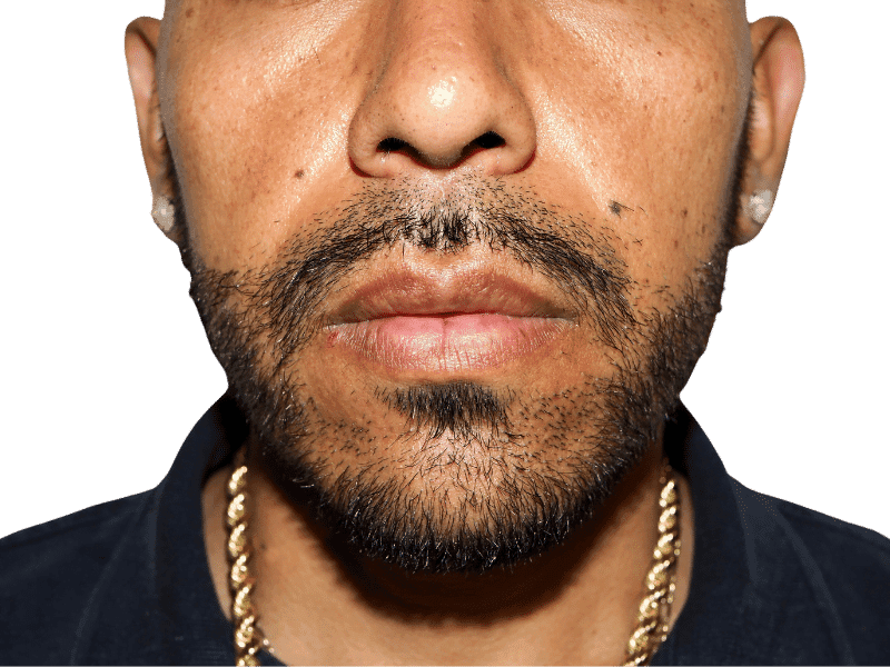 Beard Transplant Case 5 – After