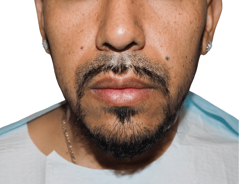 Beard Transplant Case 5 – Before