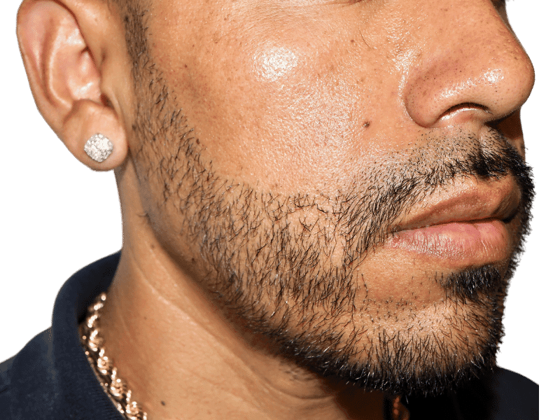 Beard Transplant Case 5 – After