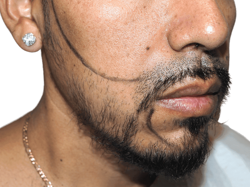 Beard Transplant Case 5 – Before