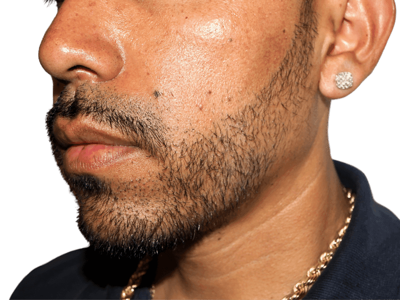 Beard Transplant Case 5 – After