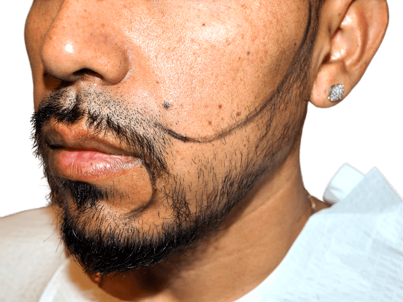 Beard Transplant Case 5 – Before