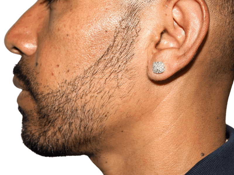 Beard Transplant Case 5 – After