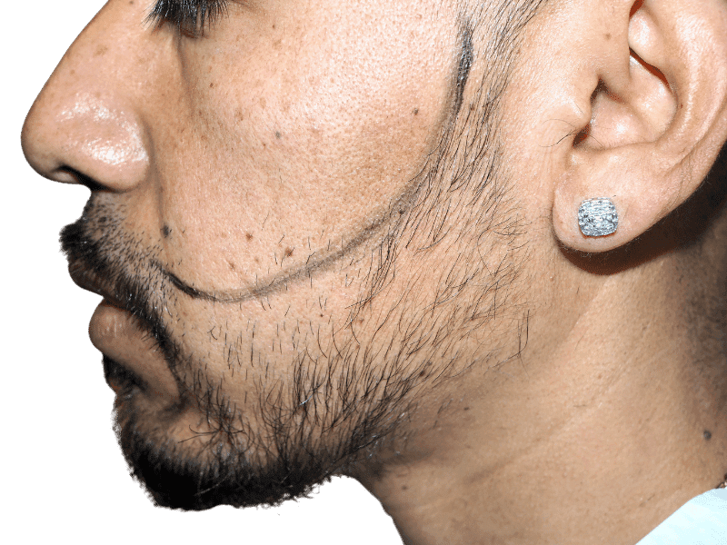 Beard Transplant Case 5 – Before