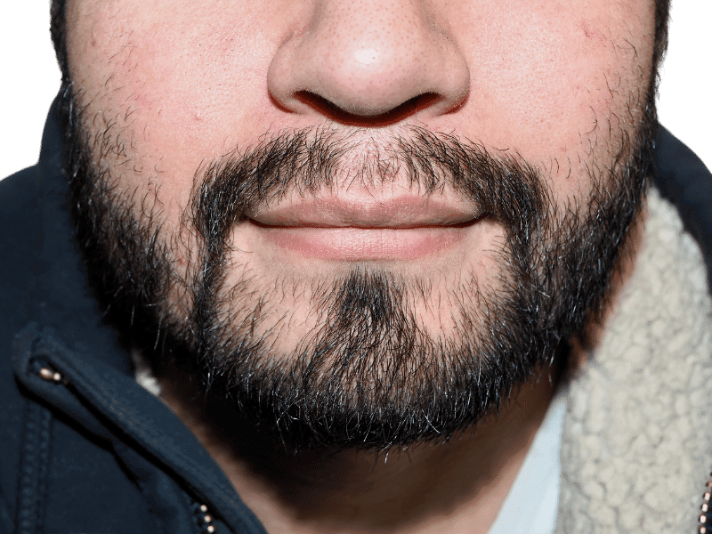 Beard Transplant Case 6 – After