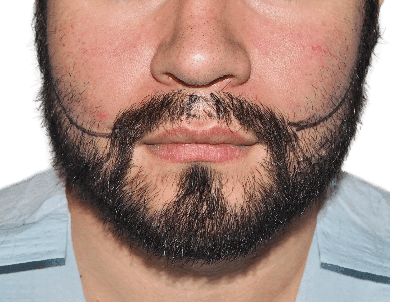 Beard Transplant Case 6 – Before