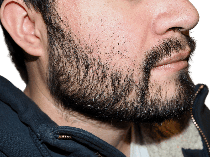 Beard Transplant Case 6 – After