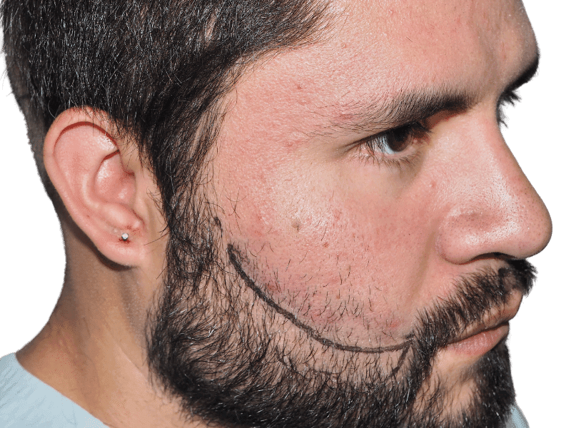 Beard Transplant Case 6 – Before