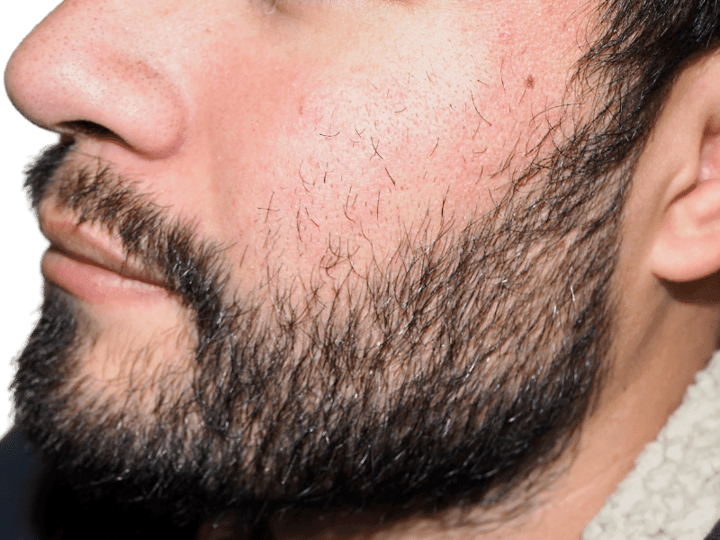 Beard Transplant Case 6 – After