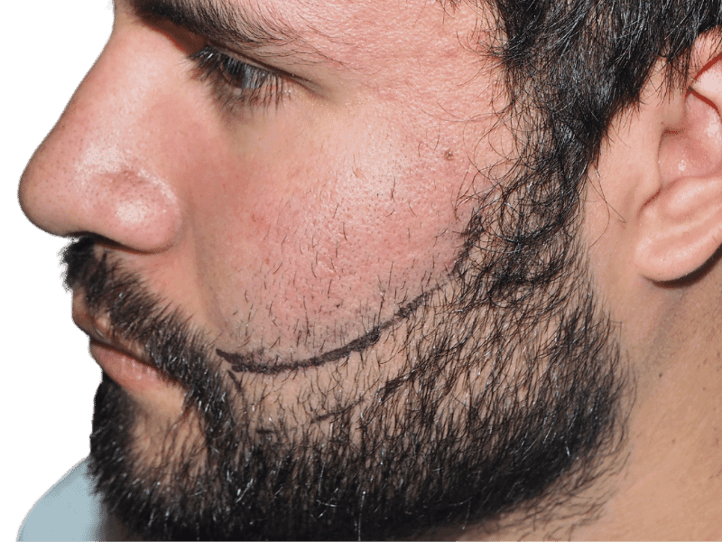 Beard Transplant Case 6 – Before