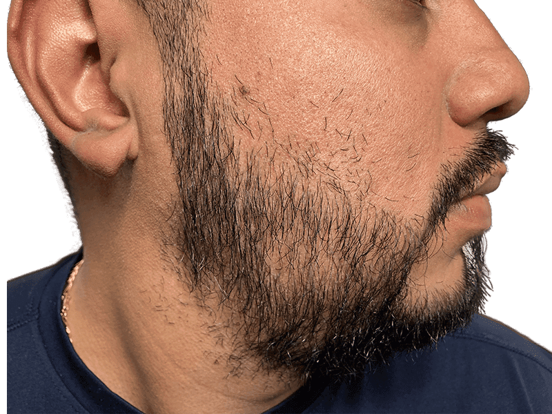 Beard Transplant Case 7 – After