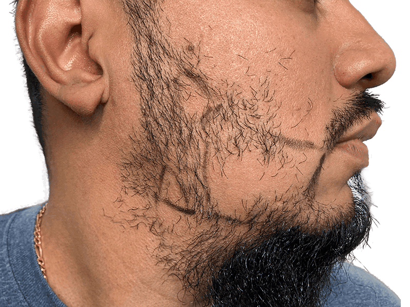 Beard Transplant Case 7 – Before